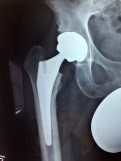 Hip replacement small