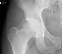 hip xray